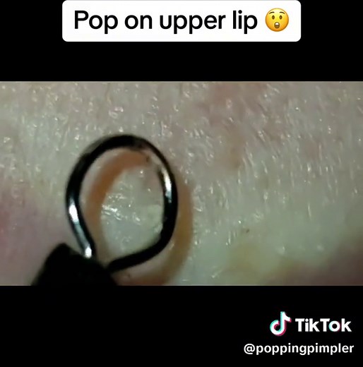 Satisfying pop on upper lip two times #satisfyingvideo #popping #beauty