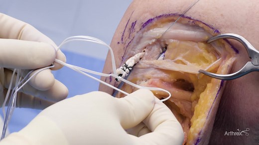 PLC Reconstruction: Collateral Ligament FiberTag® TightRope® Implants and InternalBrace™ Technique
