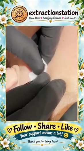 Deep Blackhead Extraction & Satisfying Popping | Wait for the most satisfying pop 😳🫣 You won’t believe what comes out! #pimplepoppersatisfying #Acne #pimple #Blackhead #Satisfying