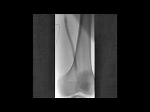 JetStream Atherectomy for In-stent Occlusion