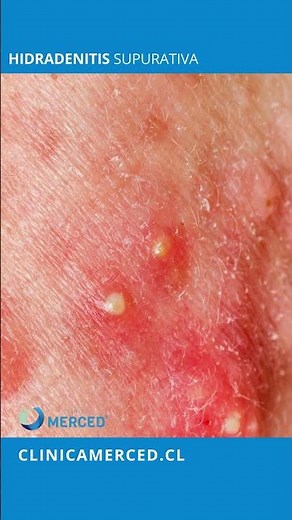 Hidradenitis Supurativa
