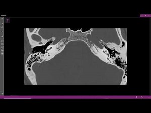 Otoesclerose otoespongiose fenestral
