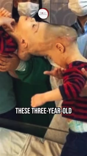 Brazilian conjoined twins separated with virtual reality technology