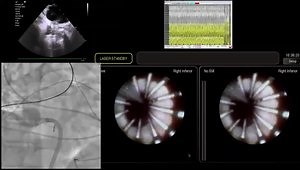 Balloon-Based PFA for Paroxysmal AF: Minimalistic ICE-Guided Workflow and Lesion Assessment