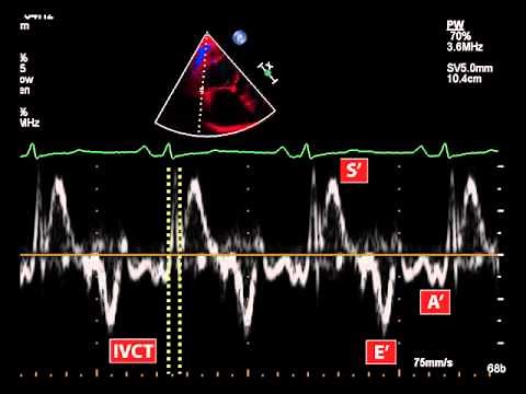 23. Myocardial performance index (Tei index) using tissue doppler