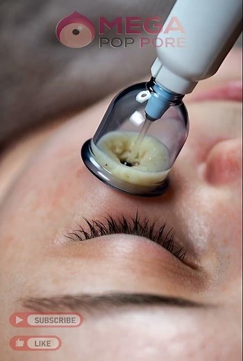 As a Dermatologist I Tried Suction Extraction for Blackheads and Here's What Happened