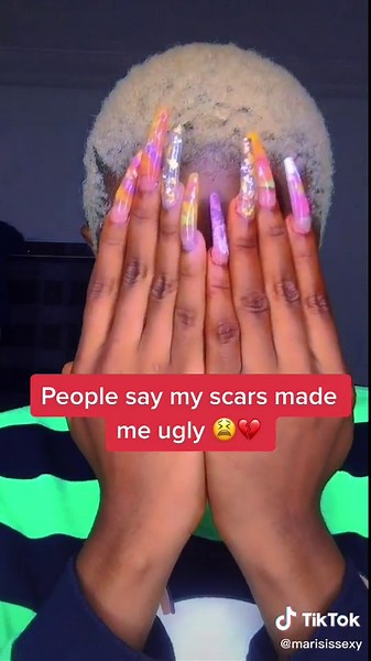 Embracing Beauty: Celebrating Scars on My Face