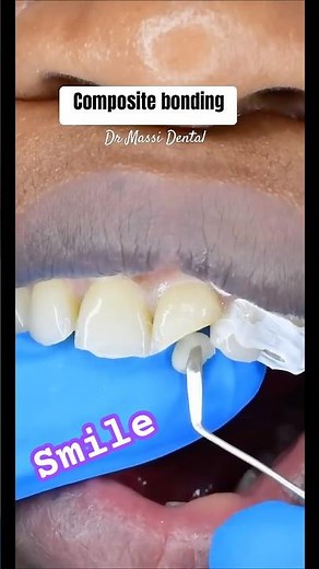 Composite Bonding Chipped Tooth fast way