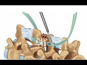 Zimmer Biomet: WALLIS Surgical Technique Animation