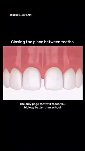 medical / biology explain | "Transforming tiny gaps into a confident smile ✨ Dental bonding is one of the simplest ways to close the space between teeth—quick,... | Instagram