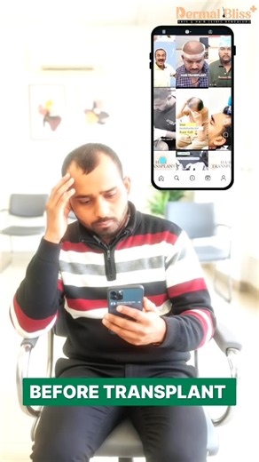 Dermal Bliss Clinic on Instagram: "Real Patient. Honest Review. Natural Hair Transplant Results. Choosing a Hair Transplant is a life-changing decision, and the most reliable proof is a real patient’s honest review. At Dermal Bliss Clinic, Indiranagar, we focus on delivering natural-looking hairlines, improved density, and permanent results through advanced FUE hair transplant techniques. This patient’s transformation reflects our personalised approach — from detailed consultation and hairline p