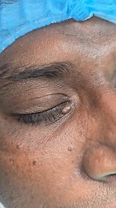 34K views · 158 reactions | Eyelid cyst | Dr Khaled's Tumour Helpline | Facebook