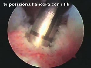 Lesione tendine sovraspinato spalla