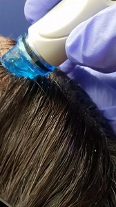 HydraFacial Keravive for Scalp & Hair