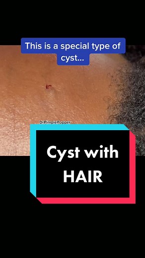 Eruptive Vellus Hair Cysts: A Fascinating Look Under the Microscope