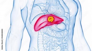 3d rendered medical animation of a malignant tumor in a man's liver
