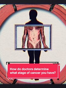 Understanding Cancer Stages: A Patient's Guide