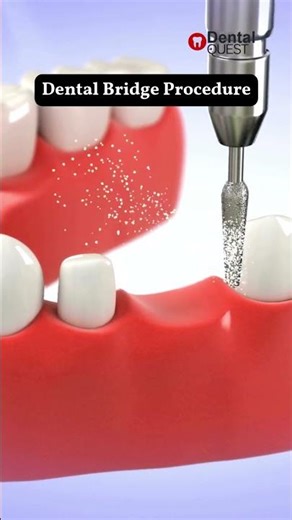 Missing a Single Tooth? 😬 Dental Bridge Is the Best Solution! | Watch How Its Done 🦷 #dentalcare