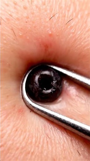 Acne Extraction with Extreme Acne Drain