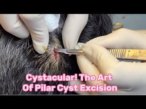 Pilar Cysts Removal Chicago