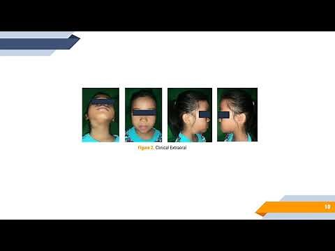 Treatment of Plunging Ranula by Marsupialization with Local Anesthesia in a Young Girl–A Case Report