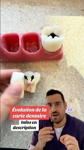 The evolution of caries: from enamel to pulp 🦷