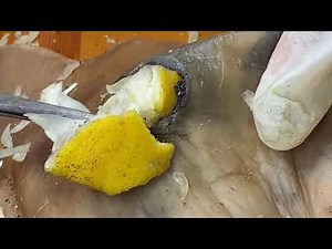 Giant Boogerswax #Satisfying The Old Man's Cystic Are Like Flowers 0808M20087