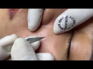 Acne Treatment Nhat Bang #14