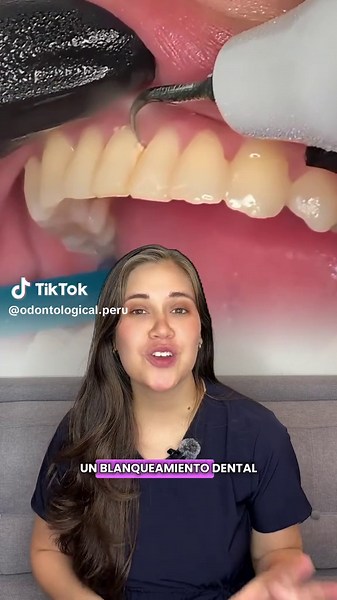 Si estas pensando en hacerte un blanqueamiento, necesitas saber esto! #higienebucal #limpiezadental #blanqueamientodental #dientesblancos #viral