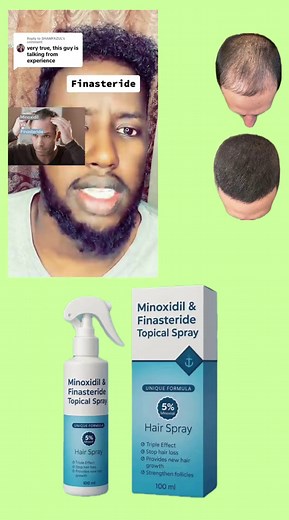 Understanding Minoxidil and Finasteride Topical Spray