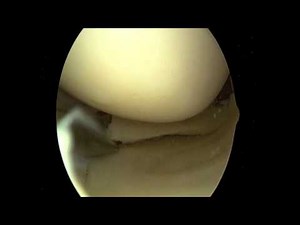 ACL Reconstruction - basic steps • Video • MEDtube.net