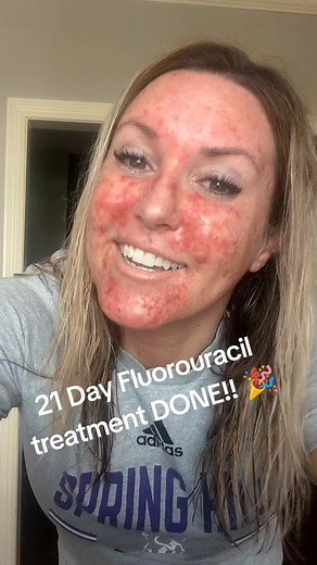 21 Days (x2 day) Fluorouracil topical treatment for AK's/precancer is finally DONE!! Now on to the healing phase 🎉 Please keep checking your skin, folks 😊 #checkyoskin #advanceddermatology #fluorouracil #efudex #actinickeratosis #basalcellcarcinoma #squamouscellcarcinoma #chemocream #precancer #dermotologist #skincare #funinthesun #vaseline
