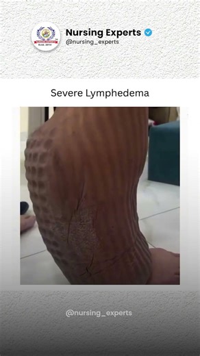 Lymphedema Explained | Causes, Symptoms, Types & Management for Nursing Exams | Nursing Experts 🩺📚