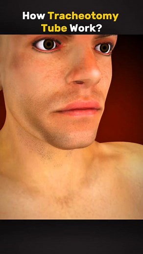 How Tracheotomy Tube Work... #videoviralシ #doctor #medicalstudent #nurselife #nurses | Nursing students KPK.