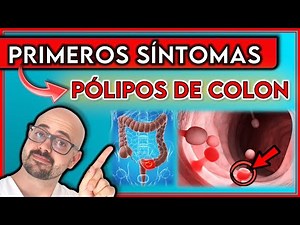 These are the first 7 symptoms of colon polyps || Don't ignore them!