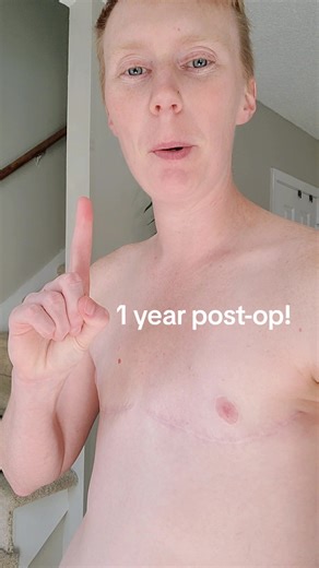 1 Year Top Surgery Post-Op Results! ✂️🏳️‍⚧️ #topsurgery #topsurgeryrecovery #topsurgeryftm #topsurgerypostop #ftm #ftmtransgender #ftn #nonbinary #trans #transition #transgender #transitions #transformation #transmasc #transmasculine #enby #genderqueer #queer #gay #gaydayoutdoors #masc #chest #scars #healing #health #healthy #mentalhealth