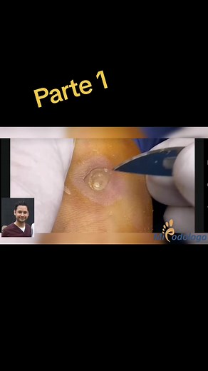 Procedimiento de Podología: Extracción de un Callo IPK