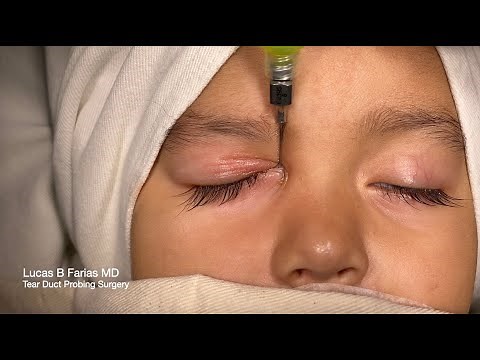 Tear Duct Probing and Irrigation