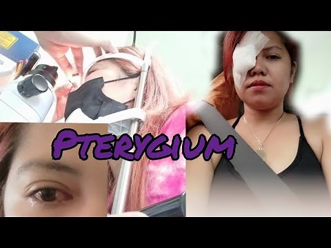 Pterygium excision with conjunctival graft, before and after eye surgery/operation, (Surfer’s eye)