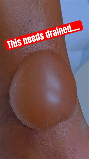 BLISTER EXPLOSION!!! 😳🤯
