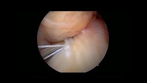 Arthroscopic Fixation of a Tibial Intercondylar Eminence Fracture