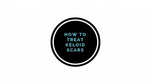 How to Treat Keloid Scars?