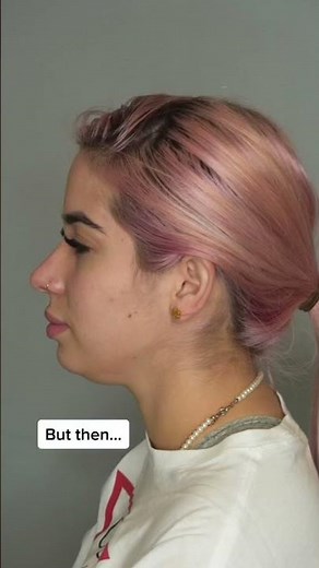 Chin Liposuction BEFORE & AFTER #plasticsurgery #beforeandafter #chinliposuction #chinlipo