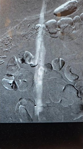 CO2 cavogram during IVC Filter retrieval