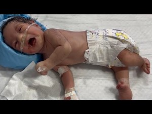 LBW Newborn With Club Foot | Oxygen-Dependent & NG Tube for Secretions | Critical NICU Care