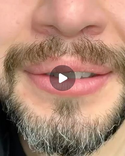 Prof. Dr. Markus B. Blatz on Instagram: "FLOWABLE INJECTION TECHNIQUE - ONE-YEAR FOLLOW UP THE PATIENT shown in this series made and sent us a video ONE YEAR after treatment completion. Note the esthetic and functional situation. While often needed, repolishing was not necessary here (yet). The patient expressed his satisfaction with the technique. Note that he is a dentist himself… I always say: “only render the type of treatment to your patient you would render to yourself if in the same situa