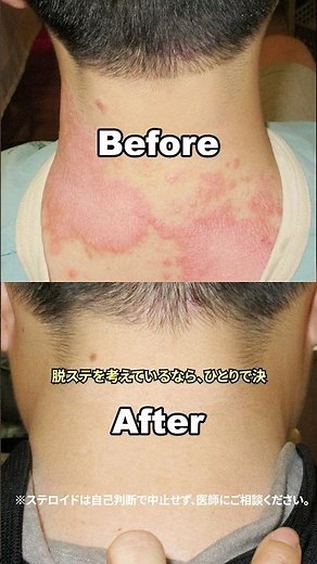 ステロイド以外の乾癬治療、その効果とは？