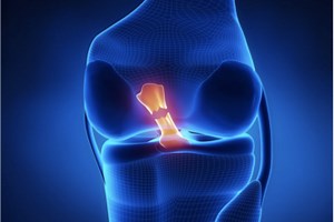 AI Prediction Models for ACL Injury Risk and Recovery Time