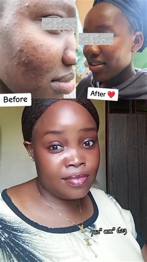 Look at this amazing transformation 🥰😍 Before & after using our skin care products #floxyskincare #skincare #skincaretips