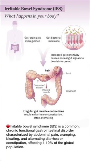 Irritable Bowel Syndrome (IBS) Explained Fast!